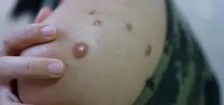 An image showing monkey pox
