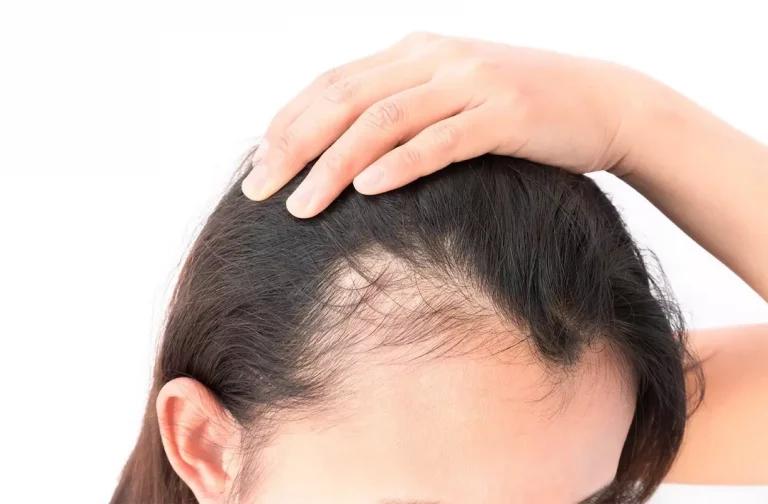 Does testosterone replacement therapy cause hair loss?