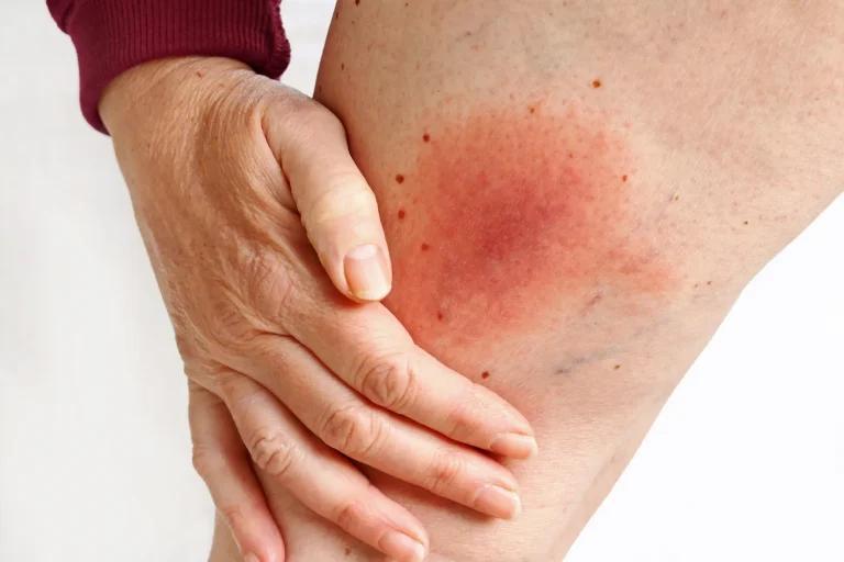Skin infection on the knee, taking a look how you can treat it with fucibet