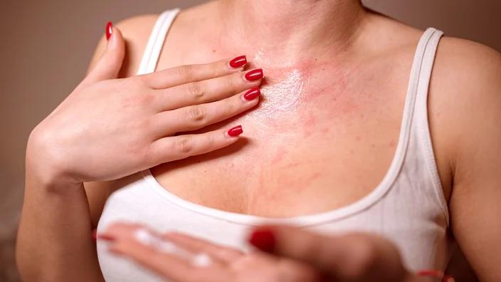woman with rash on her chest applying cream