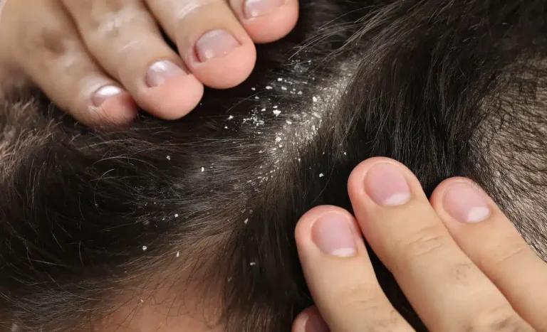 Taking a look if dandruff causes alopecia