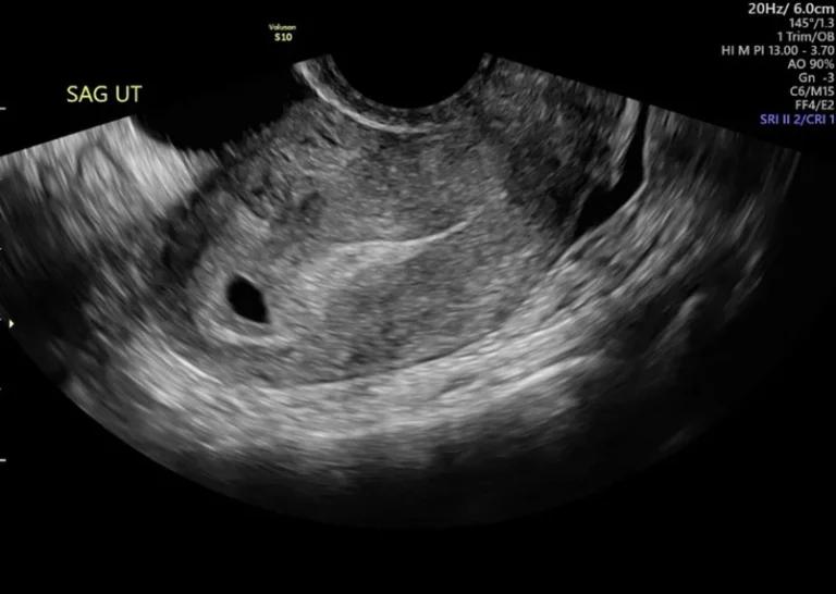 ultrasound image to see if cleft lip can be detected