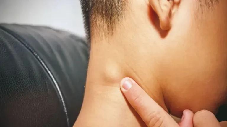 signs of lymphoma lump around the neck