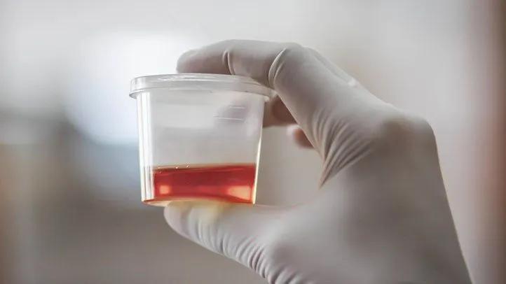 Urine in blood sample